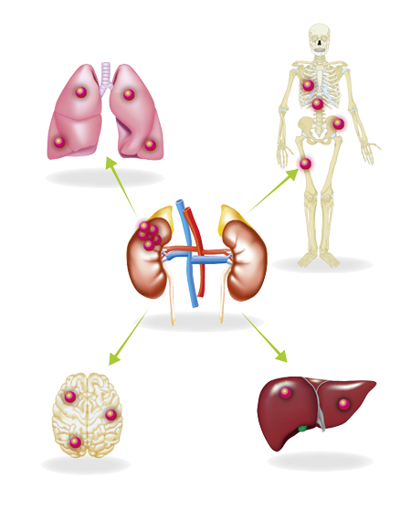 Nierenzellkarzinom Metastasen